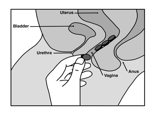 Image of putting tablets in your vagina